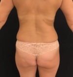 Breast Lift