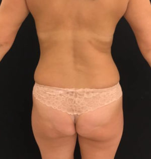 Breast Lift