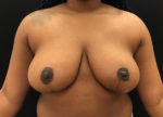 Breast Reduction