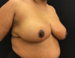 Breast Reduction