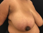 Breast Reduction