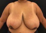 Breast Reduction
