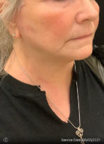Facelift