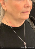 Facelift