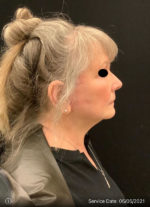 Facelift