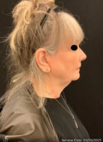 Facelift