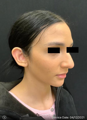 Ear Surgery