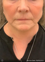 Facelift