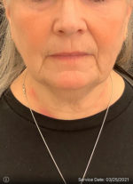 Facelift