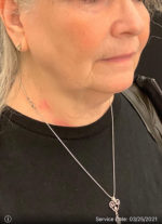 Facelift