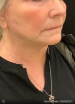 Facelift