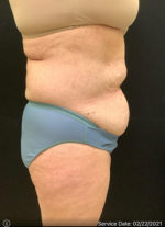 Liposuction