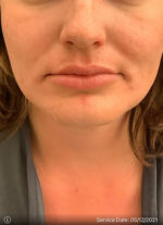 Lip Augmentation