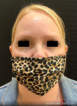 Botox Cosmetic and Dysport