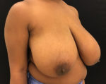 Breast Reduction