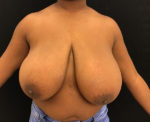 Breast Reduction