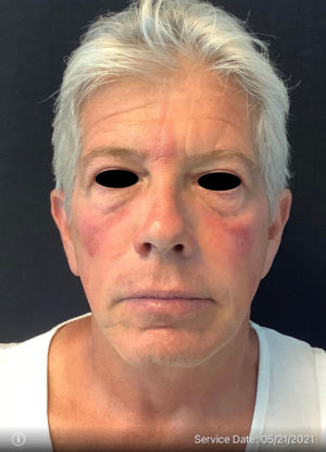 Around The Eye Fillers