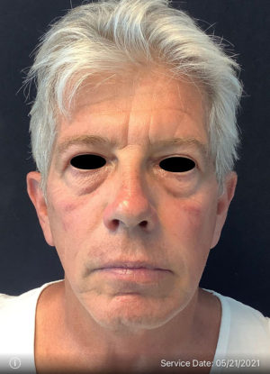 Around The Eye Fillers