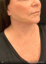 Facelift