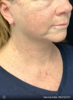 Facelift