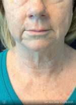 Facelift
