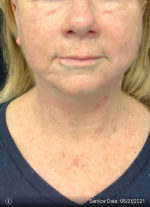 Facelift