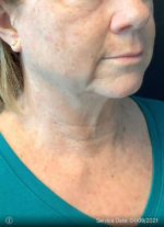 Facelift