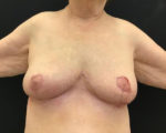 Breast Reduction