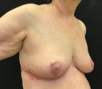 Breast Reduction
