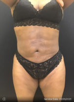 Liposuction
