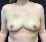 Breast Reduction