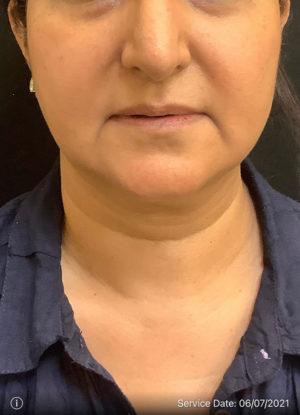 Around The Mouth Fillers