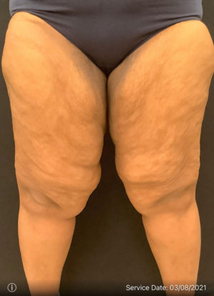 Thigh Lift