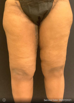 Thigh Lift