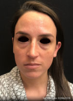 Around The Eye Fillers