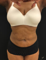 Liposuction