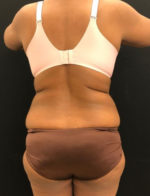 Liposuction
