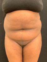 Liposuction