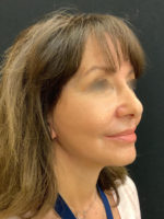 Facelift