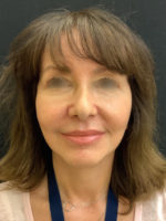 Facelift