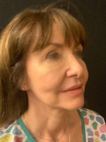 Facelift