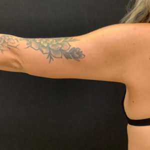 Brachioplasty