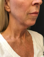 Facelift