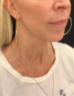 Facelift