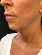 Facelift