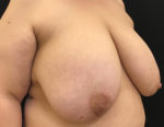 Breast Reduction