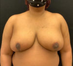 Breast Reduction