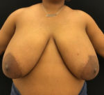 Breast Reduction