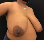 Breast Reduction
