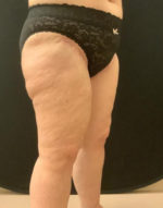 Thigh Lift